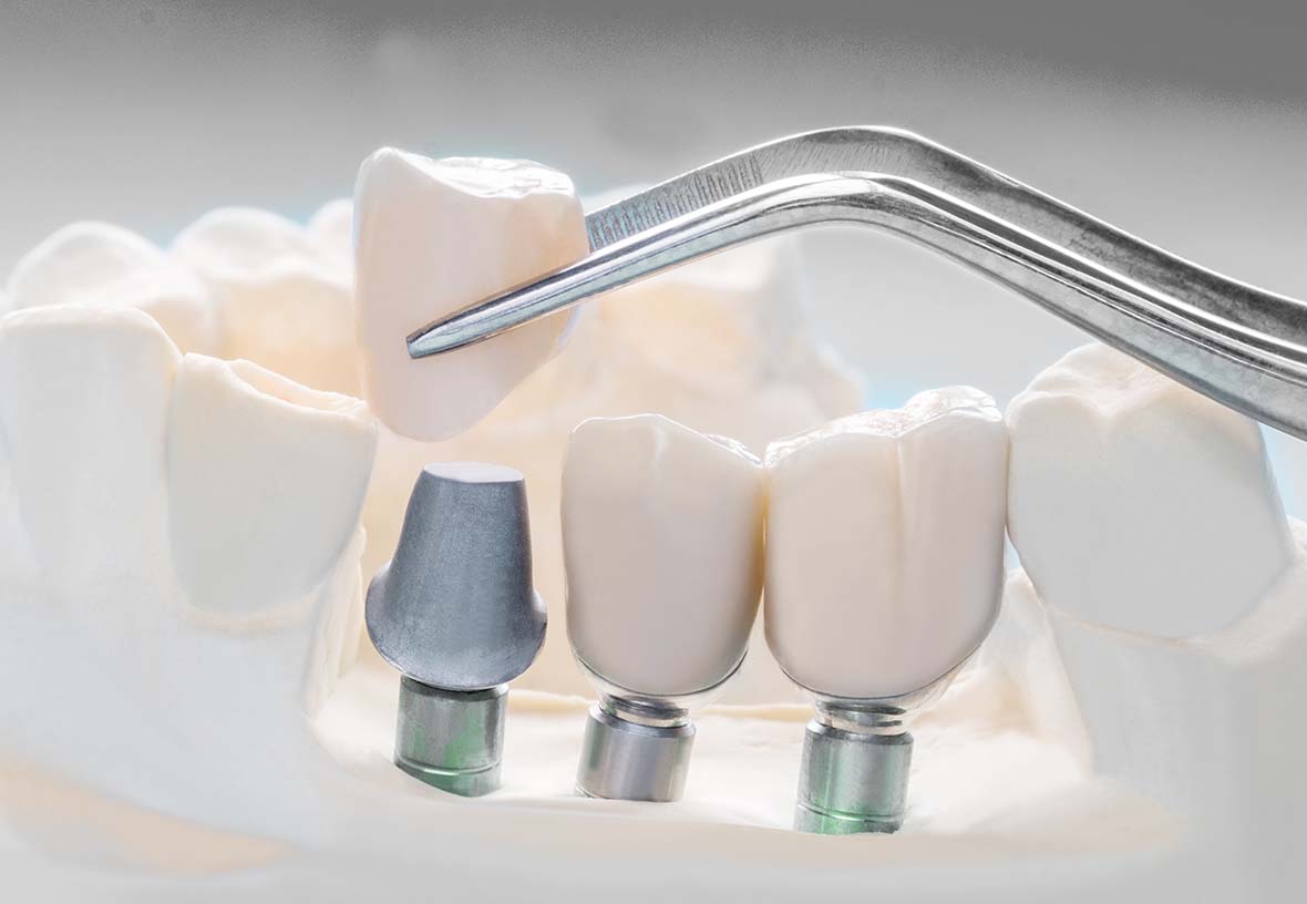 Dental Implants in Dartmouth Dental Centre